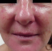 Rosacea before IPL Treatment