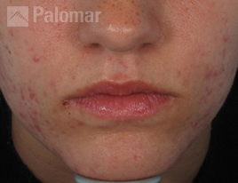 Acne before IPL Treatment