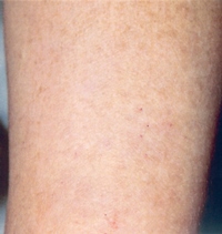 Age Spots after IPL Treatment
