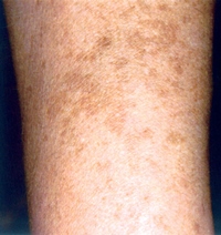 Age Spots before IPL Treatment