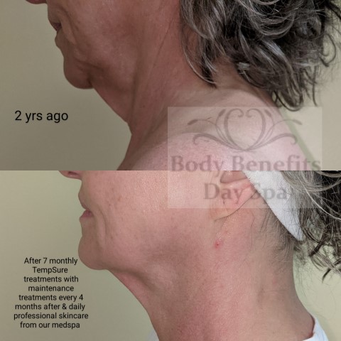 Before-and-After-TempSure-RF-Skintightening-Laser-Treatments