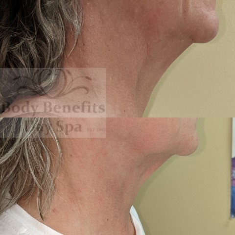 Before-and-After-TempSure-RF-Skintightening-Laser-Treatments