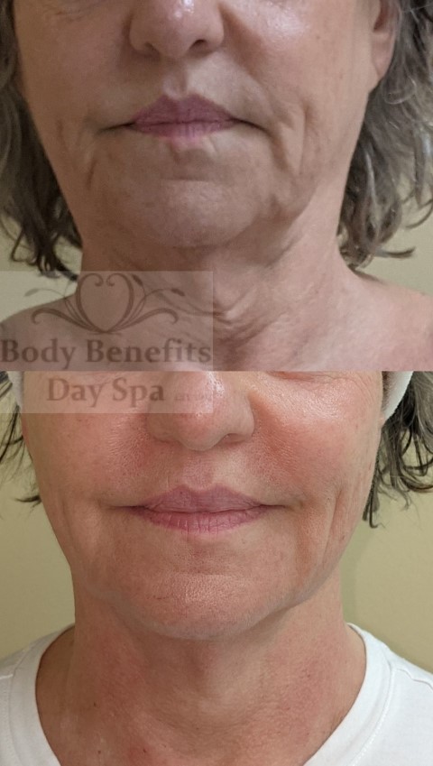 Before-and-After-TempSure-RF-Skintightening-Laser-Treatments