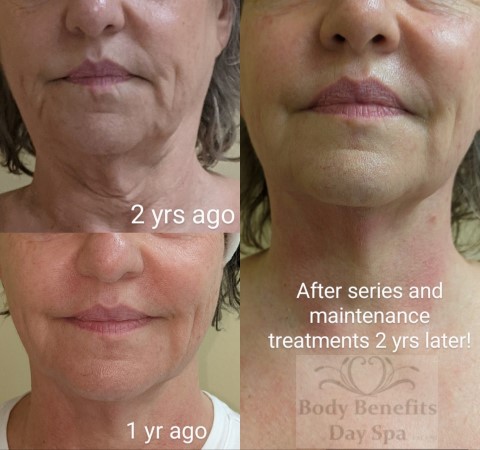 Before-and-After-TempSure-RF-Skintightening-Laser-Treatments