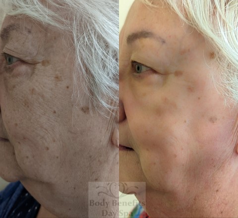 Before-And-Afters/Before-and-after-8-TempSure-RF-Skintightening-Laser-Treatments