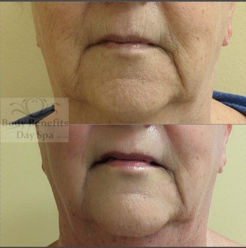 Before-And-Afters/Before-and-after-8-TempSure-RF-Skintightening-Laser-Treatments