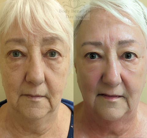 Before-And-Afters/Before-and-after-8-TempSure-RF-Skintightening-Laser-Treatments