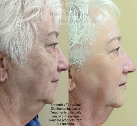 Before-And-Afters/Before-and-after-8-TempSure-RF-Skintightening-Laser-Treatments