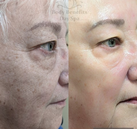 Before-And-Afters/Before-and-after-8-TempSure-RF-Skintightening-Laser-Treatments