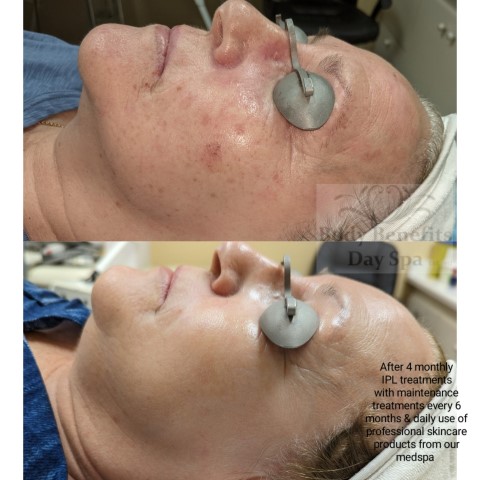 Before-and-after-IPL