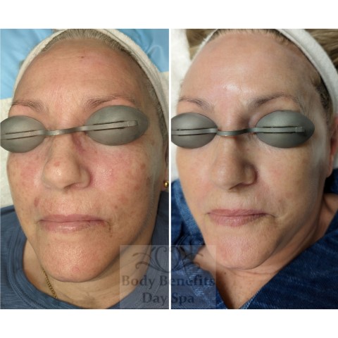 Before-and-after-IPL