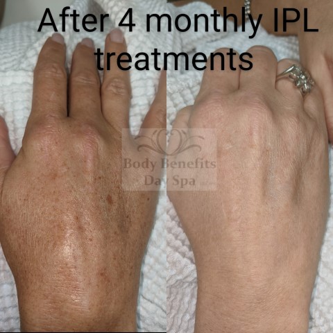 Before-and-after-IPL