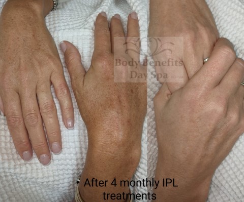 Before-and-after-IPL
