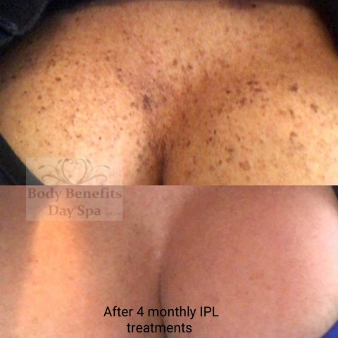 Before-and-after-IPL