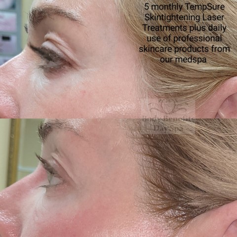Before-and-after-TempSure