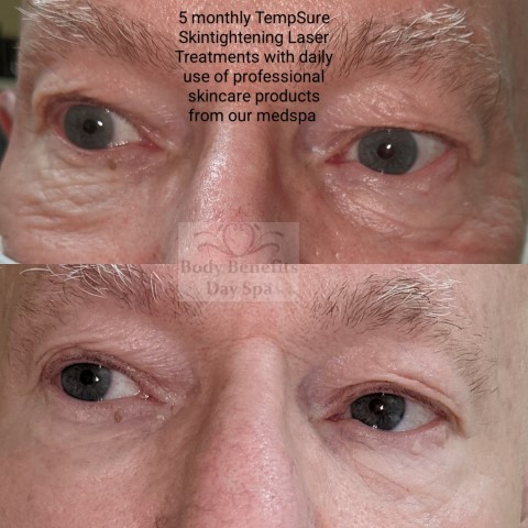 Before-and-after-TempSure