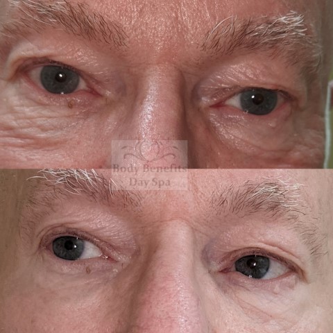 Before-and-after-TempSure