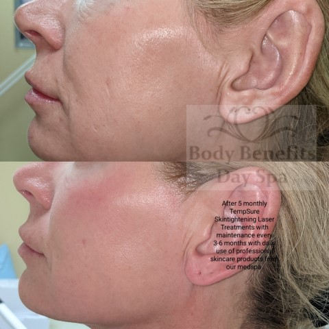 Before-and-after-TempSure